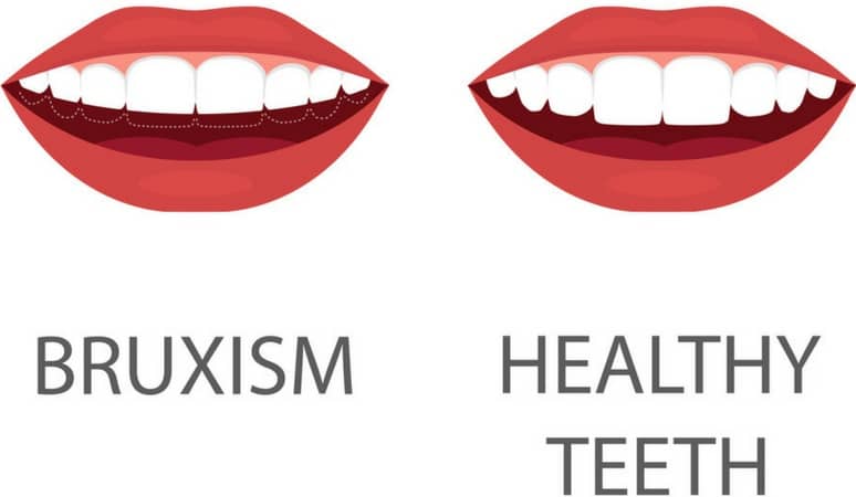 Bruxism Dental Night Guard Side Effects
